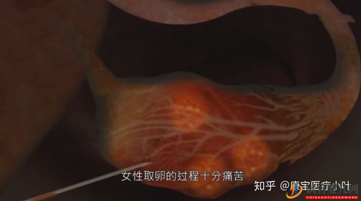 做试管婴儿有多痛,几张3D模拟图,看完全过程后心(图1) 做试管婴儿有多痛,几张3D模拟图,看完全过程后心(图1)
