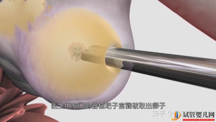 做试管婴儿有多痛,几张3D模拟图,看完全过程后心(图4) 做试管婴儿有多痛,几张3D模拟图,看完全过程后心(图4)