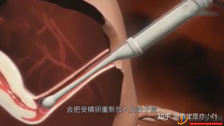 做试管婴儿有多痛,几张3D模拟图,看完全过程后心(图8) 做试管婴儿有多痛,几张3D模拟图,看完全过程后心(图8)