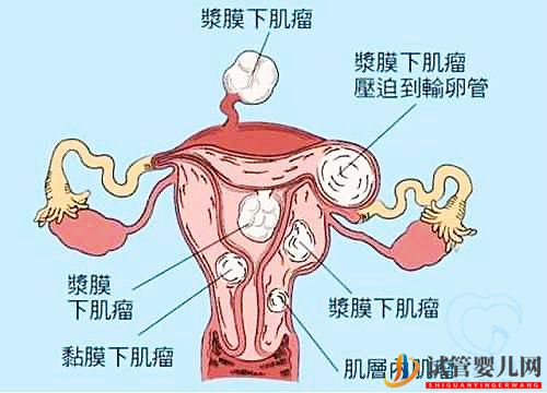 多发性子宫肌瘤可以做试管婴儿吗?你都了解吗(图1) 多发性子宫肌瘤可以做试管婴儿吗?你都了解吗(图1)