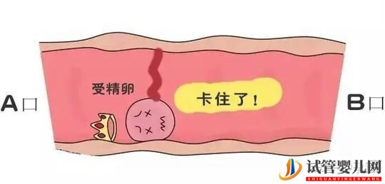 输卵管堵塞还想怀宝宝!能够做泰国试管婴儿吗(图3) 输卵管堵塞还想怀宝宝!能够做泰国试管婴儿吗(图3)