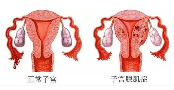 子宫腺肌症能去跟吗?有效的治疗方案大全(图1) 子宫腺肌症能去跟吗?有效的治疗方案大全(图1)