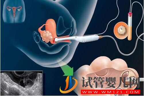 人工授精和试管婴儿的区别及手术费用是多少?(图2) 和田人工授精和试管婴儿的区别及手术费用是多少?(图2)