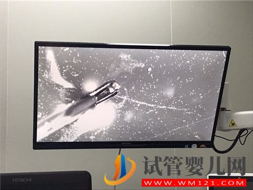 左侧卵巢被割除、三次试管失败她该怎么办?(图2) 左侧卵巢被割除、三次试管失败她该怎么办?(图2)
