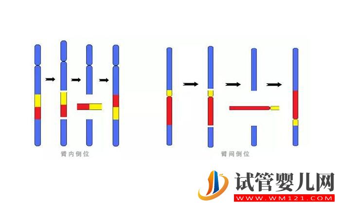 染色体平衡易位能做试管手术吗 要注意哪些问题(图2) 染色体平衡易位能做试管手术吗 要注意哪些问题(图2)