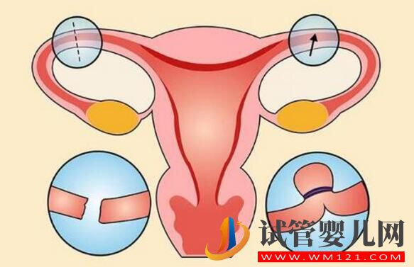 女人结扎了可以做试管婴儿吗?来看看吧(图1) 铜仁女人结扎了可以做试管婴儿吗?来看看吧(图1)