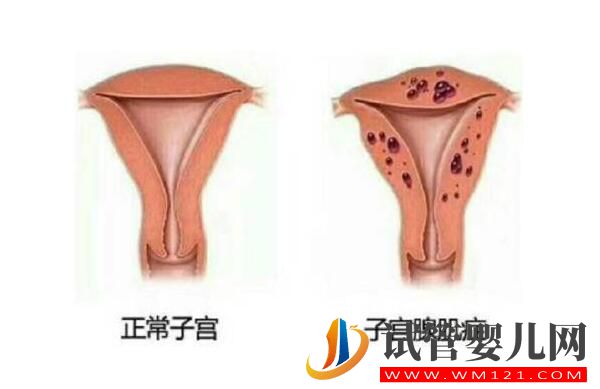 子宫腺肌症能做试管婴儿吗?应该如何备孕(图1) 子宫腺肌症能做试管婴儿吗?应该如何备孕(图1)