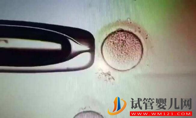 子宫腺肌症能做试管婴儿吗?应该如何备孕(图4) 子宫腺肌症能做试管婴儿吗?应该如何备孕(图4)