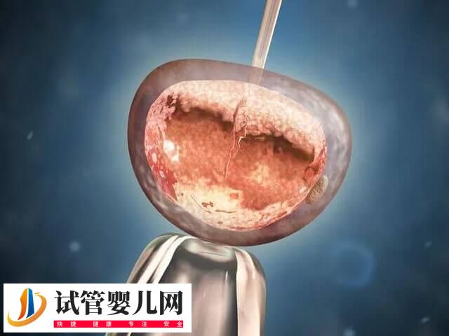 冻胚移植前要做哪些准备