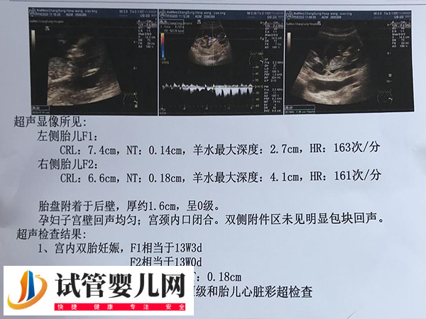日本试管婴儿双胞胎几率有多大